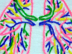 Update on "Totally Drug Resistant" Tuberculosis Update on "Totally Drug Resistant" Tuberculosis